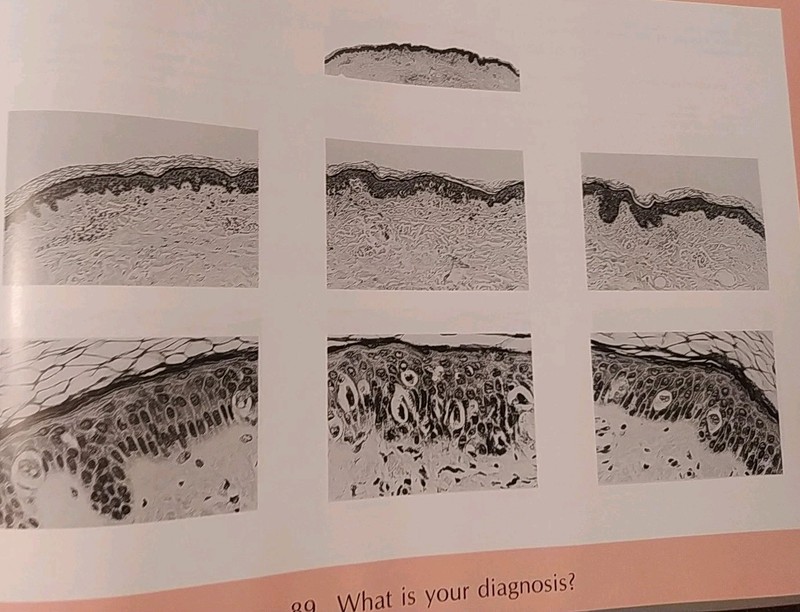 Pitfalls in Histopathologic Diagnosis of Malignant Melanoma A B Ackerman gallery