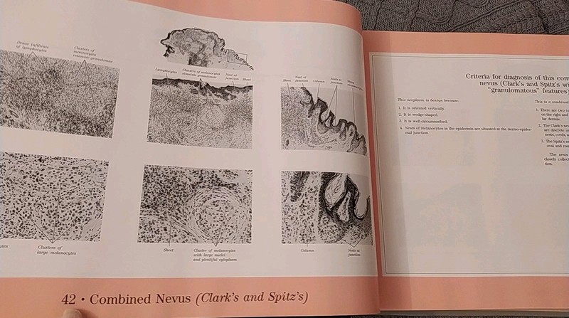 Pitfalls in Histopathologic Diagnosis of Malignant Melanoma A B Ackerman gallery